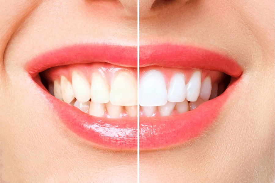 Why Dentists Provided Teeth Whitening Treatments Are Optimal?