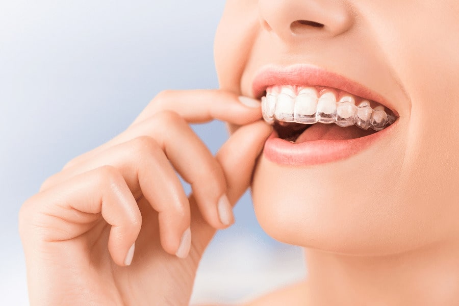 How to Eat With Invisalign