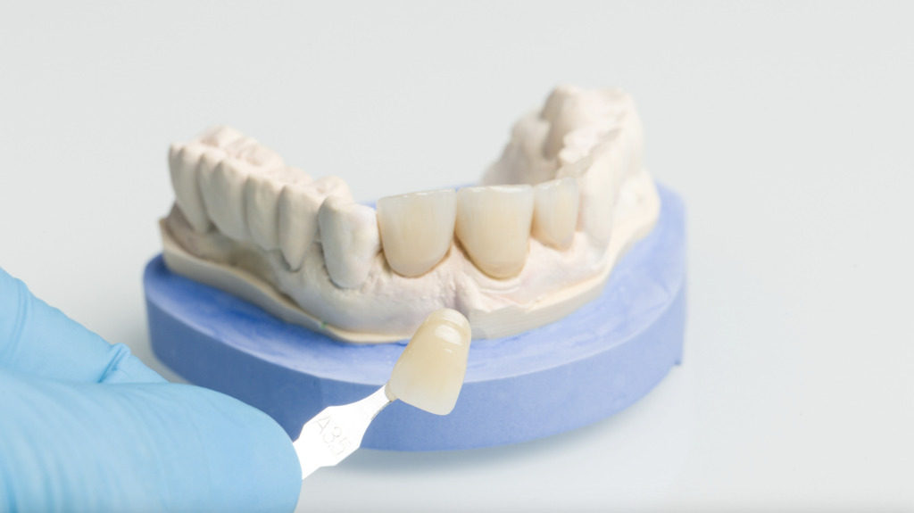 Porcelain Crowns vs Veneers