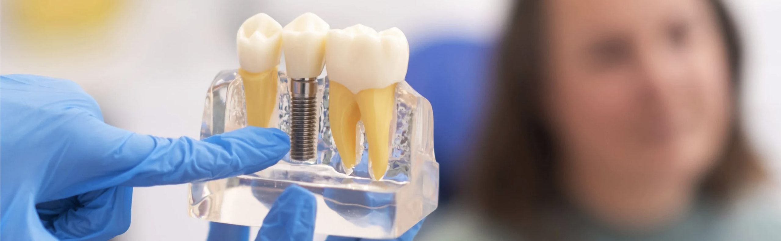 How to Take Care of Full Mouth Dental Implants: Complete Guide