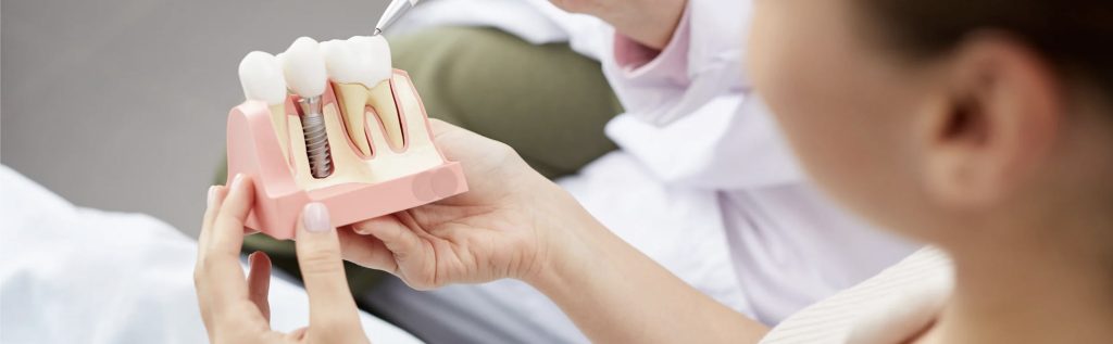 What is the Best Option for Dental Implants? What is the Best Option for Dental Implants?