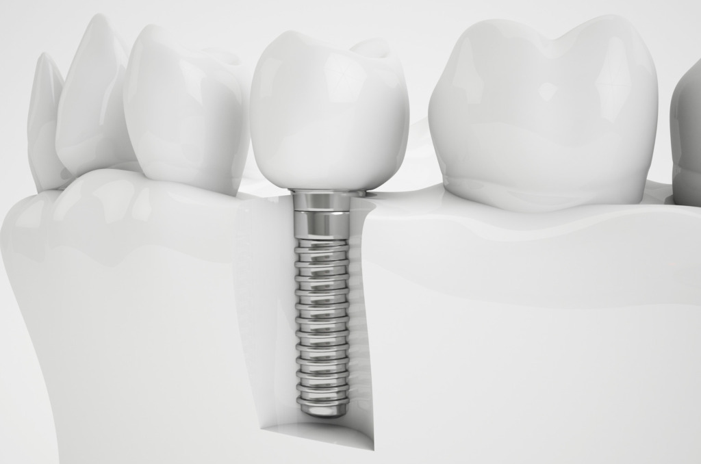 Are Dental Implants Safe? What You Need to Know