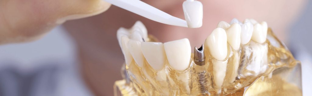 How Strong Are Dental Implants Compared to Natural Teeth? How Strong Are Dental Implants Compared to Natural Teeth?