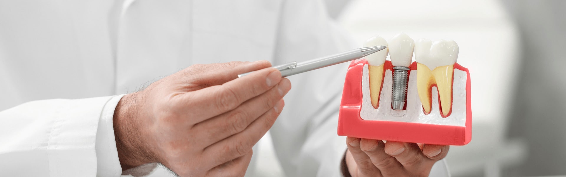 Are Dental Implants Safe? What You Need to Know