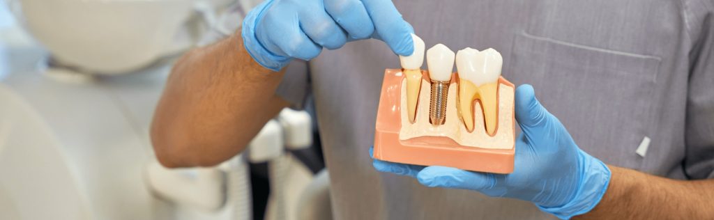 What is non surgical implant What is non surgical implant