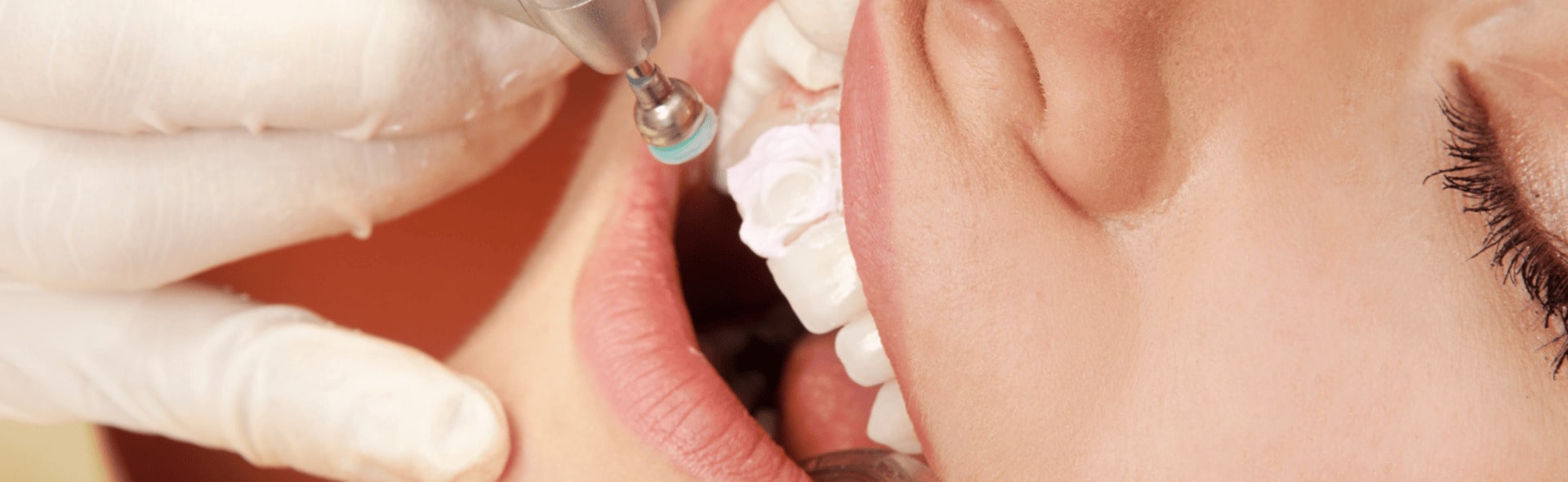 The Pros and Cons of Dental Bonding: What You Need to Know
