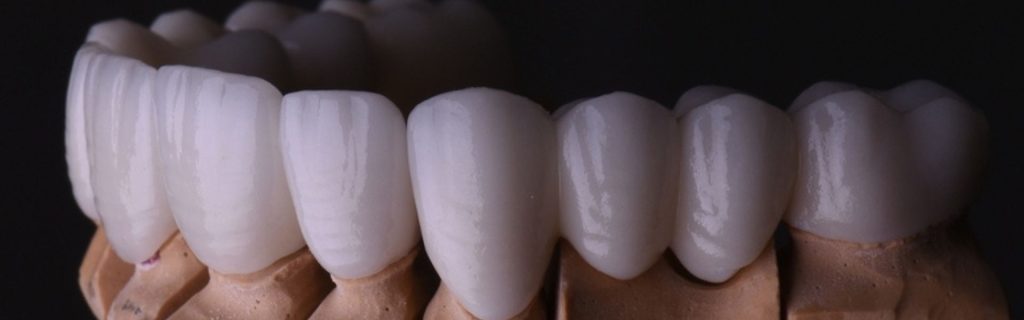 Dental Crowns Types Dental Crowns Types