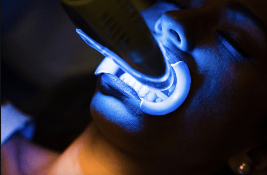 Tips to Prevent Sensitivity During Whitening