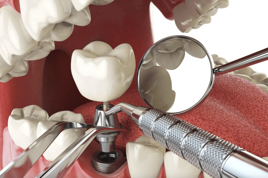 Treatment Options for Receding Gums Before Implants