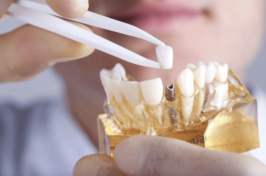 Key Factors to Consider When Choosing a Dental Implant Specialist