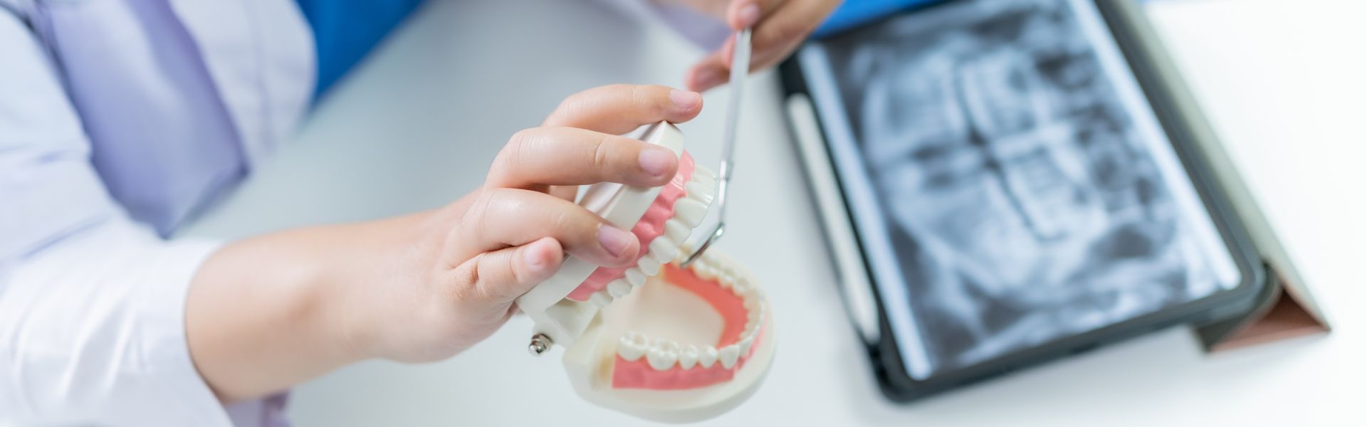 Implant Bridge Dental