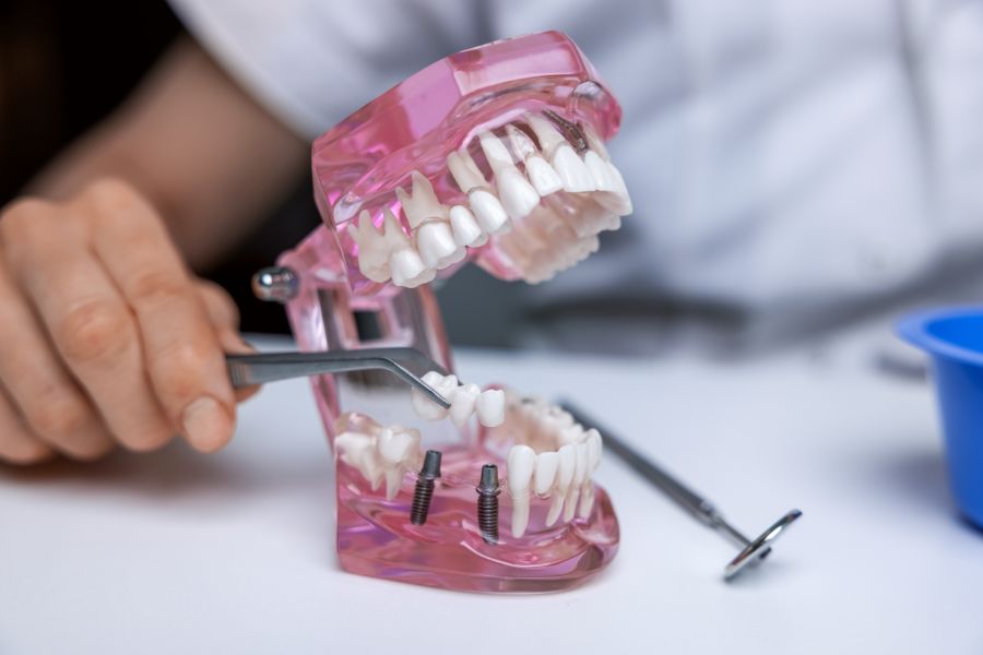 Implant Bridge Dental: What You Need to Know