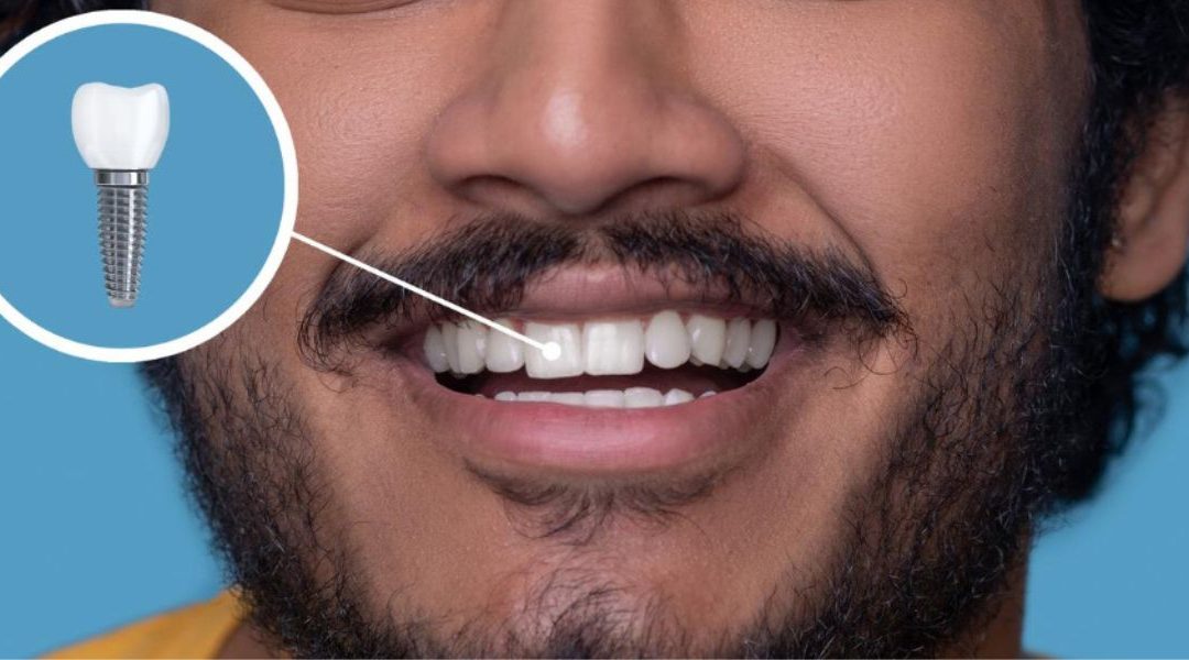 Dental Abutment Implant