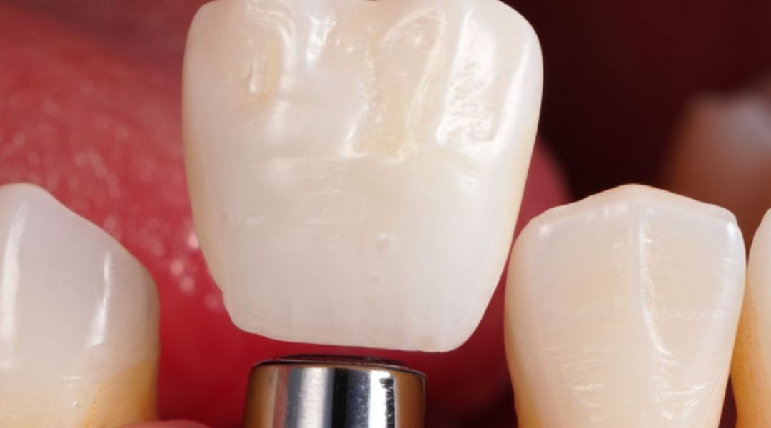 Can Dental Implants Get Cavities?