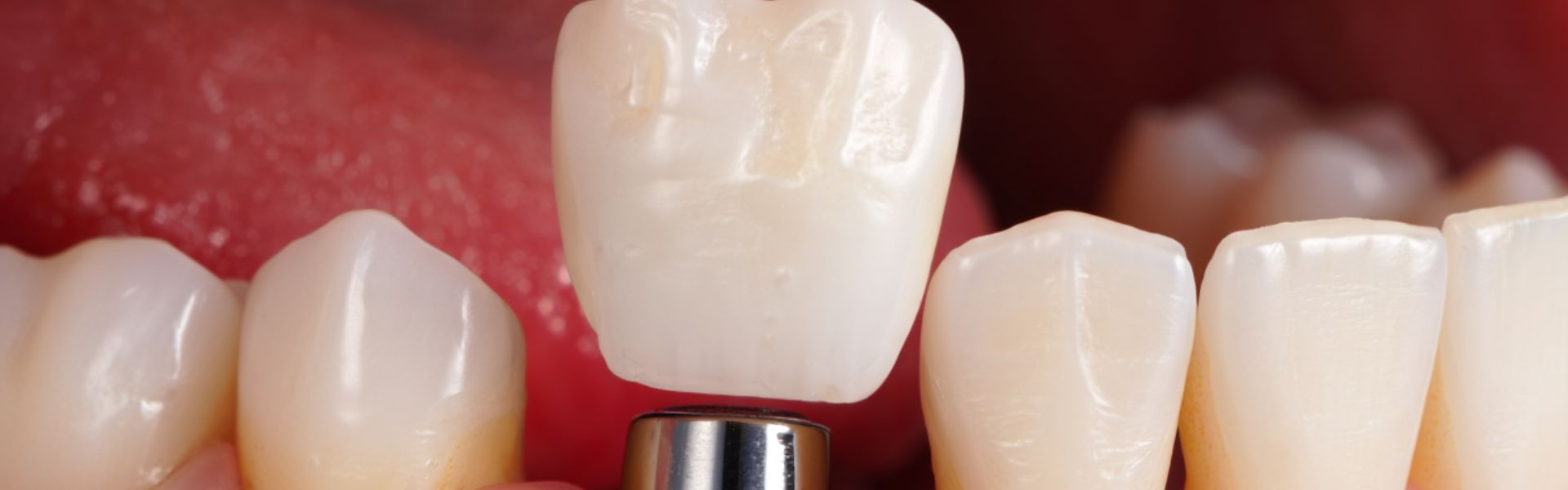 Do Dental Implants Get Cavities