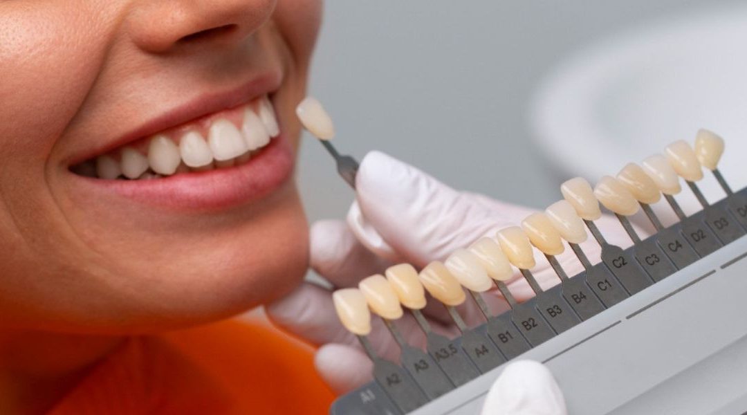 Different Types of Dental Veneers