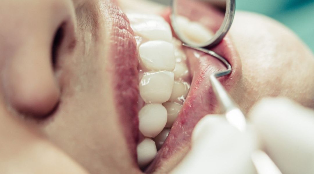 Uneven Bite After a Cavity Filling