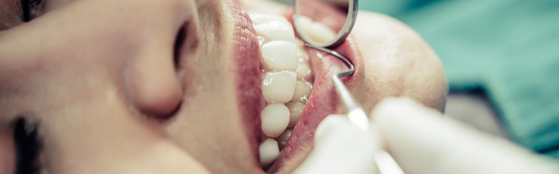 Uneven Bite After a Cavity Filling