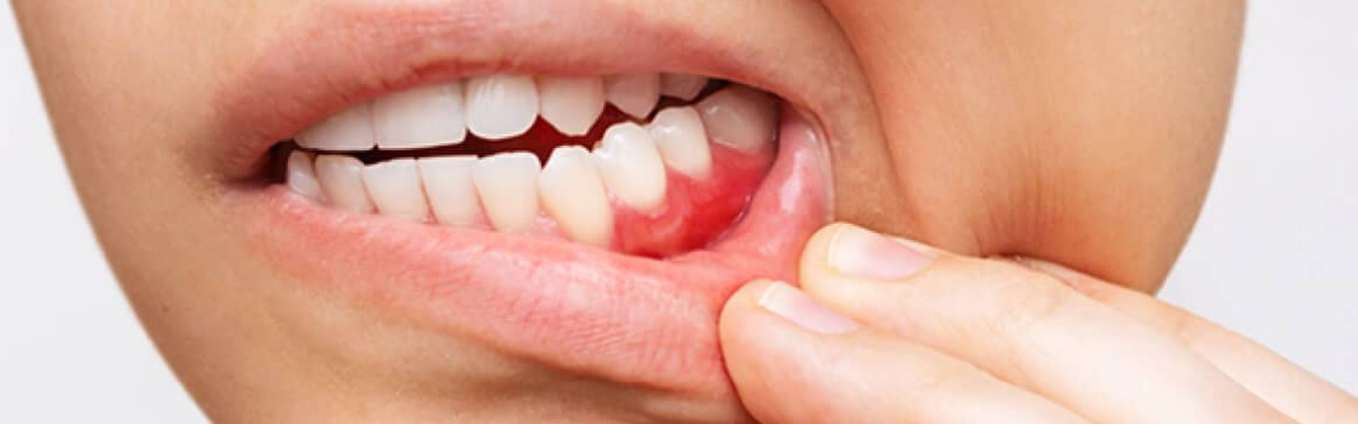 Why Are My Gums Bleeding?