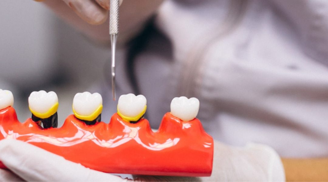 How to Prevent and Treat Dental Bridge Problems