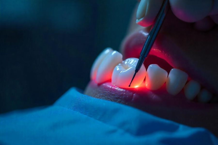 Dental Inlay vs Onlay: Key Differences Explained