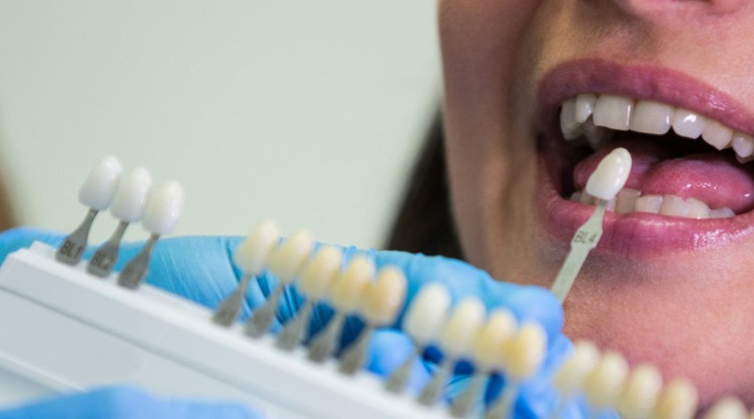 How Long Do Dental Veneers Last?