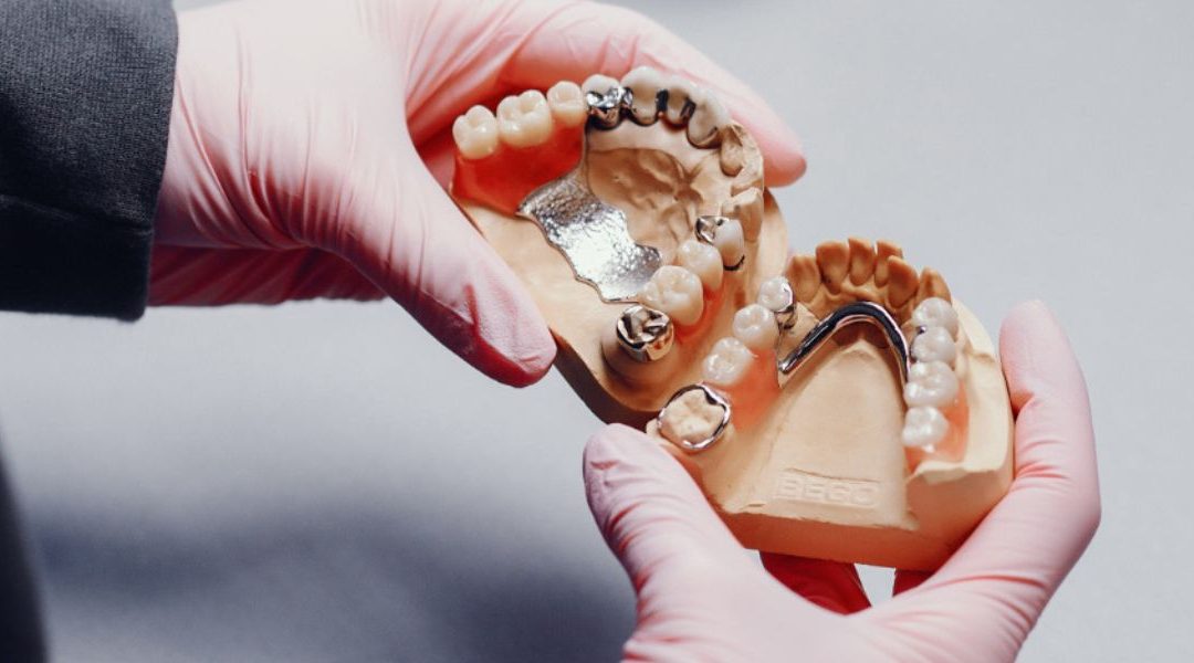 How to Treat a Cavity Under Your Dental Bridge