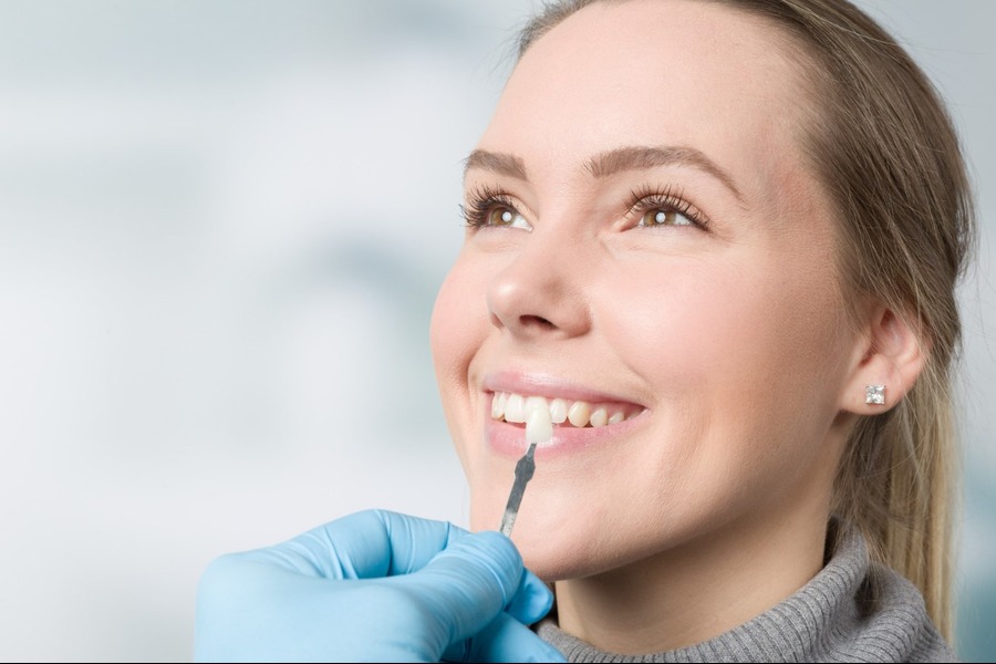 Dental Veneers: How Long Last on Average?