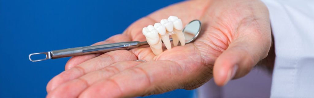 Dental Bridge for Missing Tooth Dental Bridge for Missing Tooth