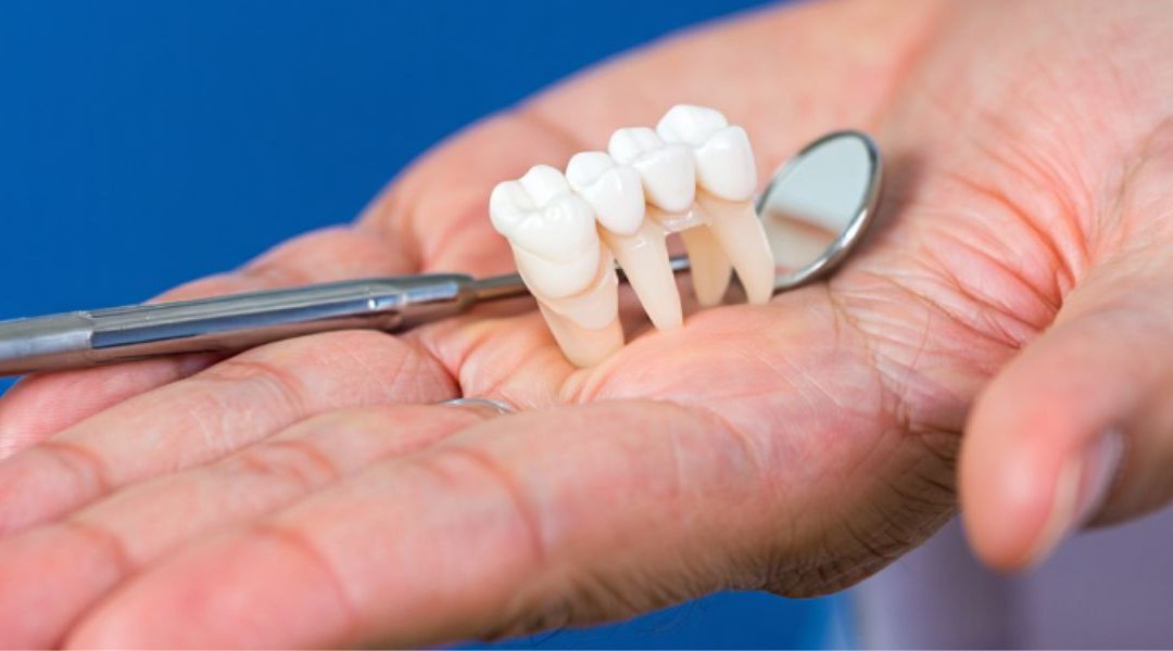Dental Bridge for Missing Tooth