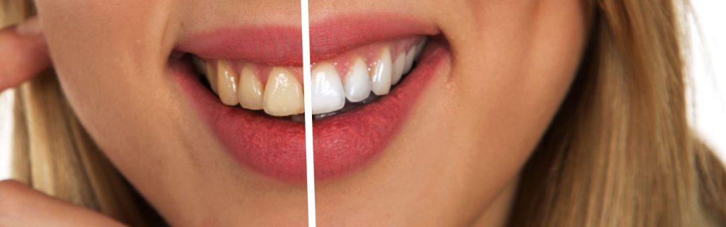 Fix Yellow Teeth Fix Yellow Teeth