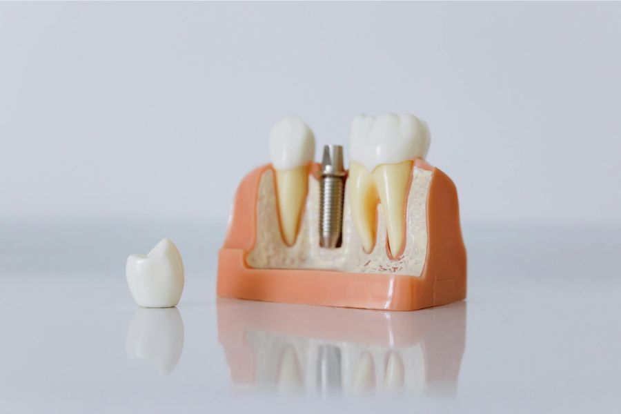 How Mini Implants Differ from Traditional Implants