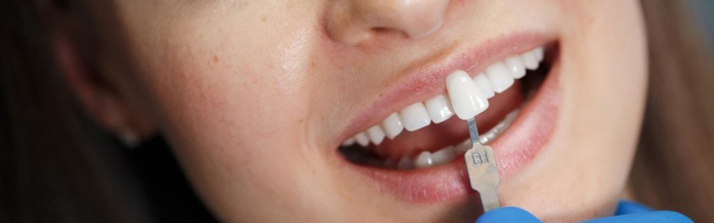 How Veneers Can Close Gaps Between Teeth
