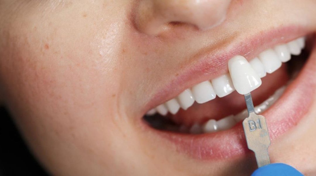 How Veneers Can Close Gaps Between Teeth
