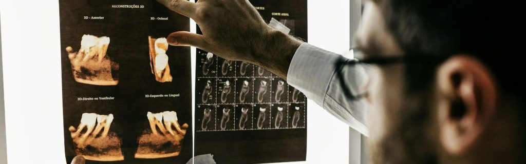 Dental X-Rays What You Need to Know
