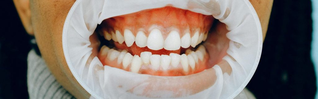Gum Graft Alternatives for Treating Receding Gums