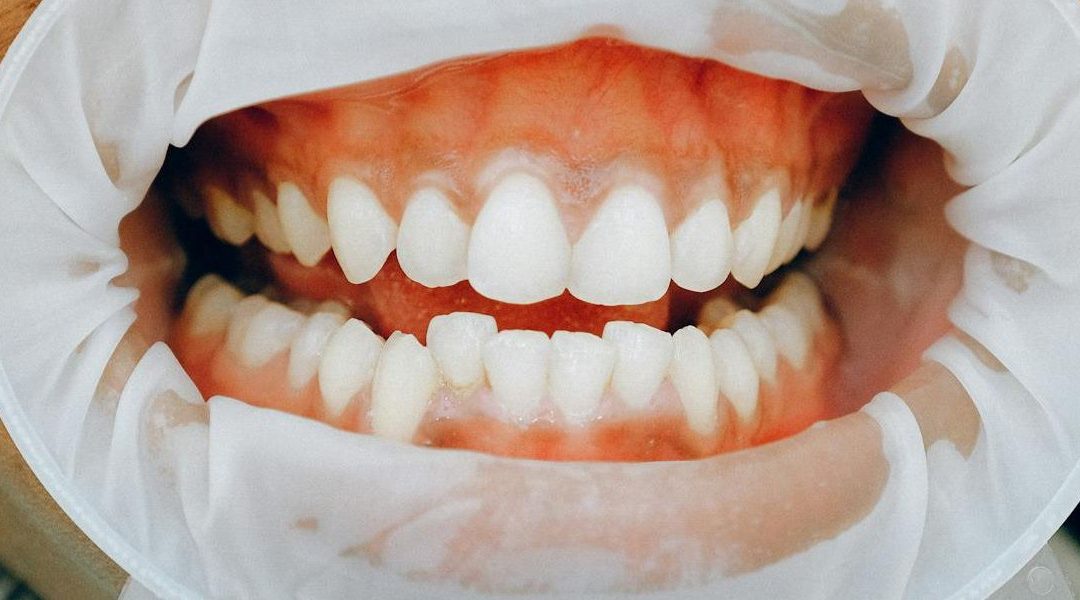 Gum Graft Alternative Treatments