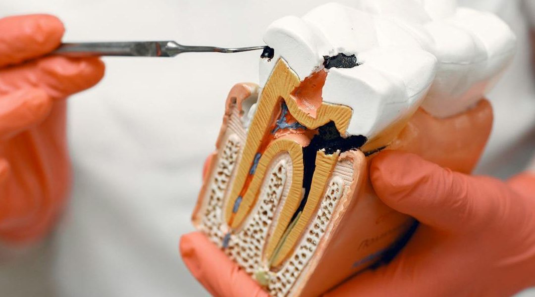 How to Prevent Tooth Decay Effectively