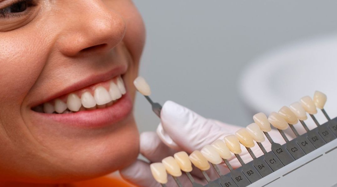Composite Veneers: Enhance Your Smile