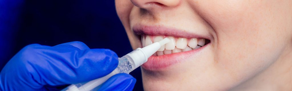 Do Teeth Whitening Pens Work