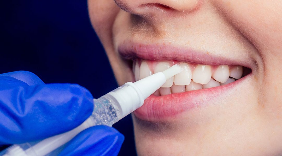 Do Teeth Whitening Pens Work?