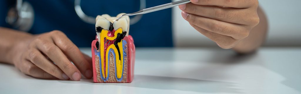 Root Canal Retreatment: A Second Chance to Save Your Tooth