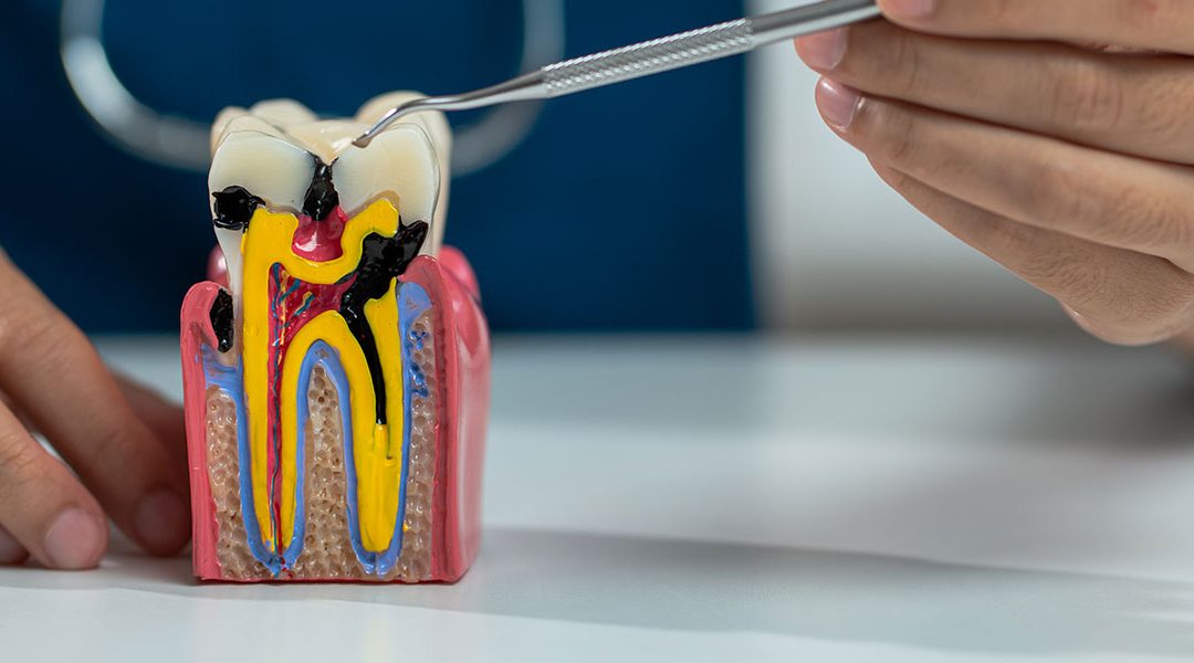 Root Canal Retreatment: A Second Chance to Save Your Tooth