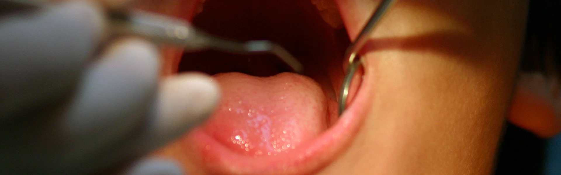 Blood Blisters in the Mouth