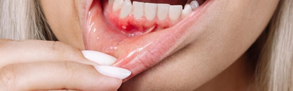 bump on gums bump on gums