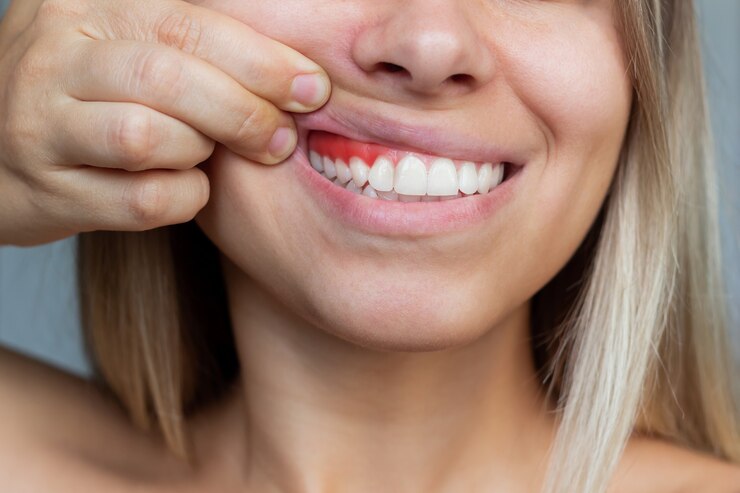 gum disease symptoms