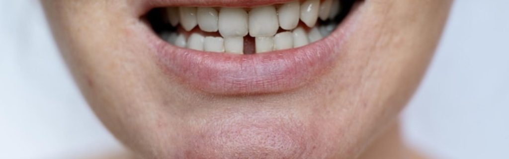 loose tooth