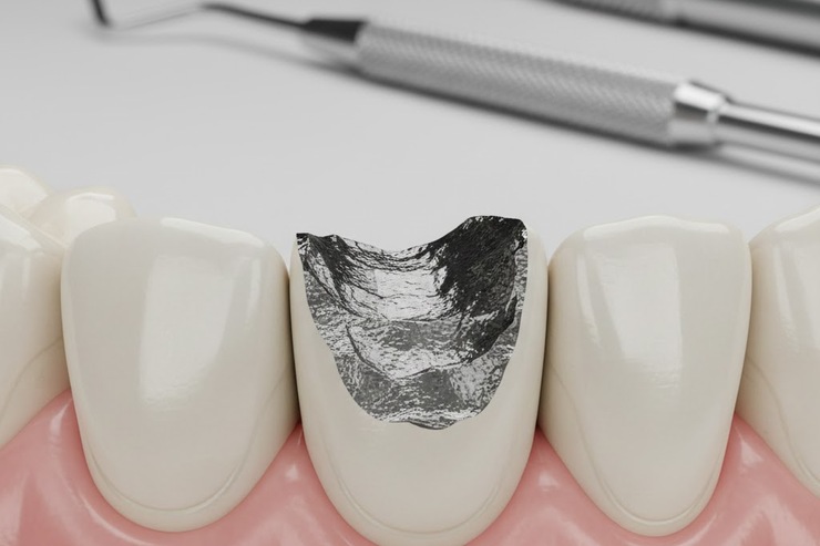Chipped Crown with Metal Exposed