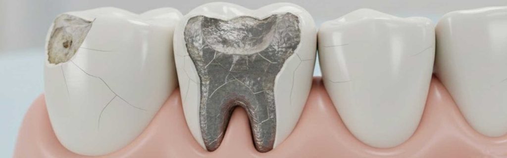 Chipped Tooth Crown Chipped Tooth Crown