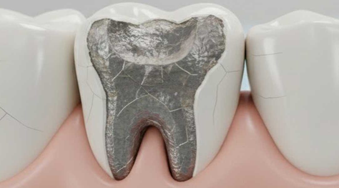 Chipped Tooth Crown? Here’s Everything You Need to Know and How to Fix It